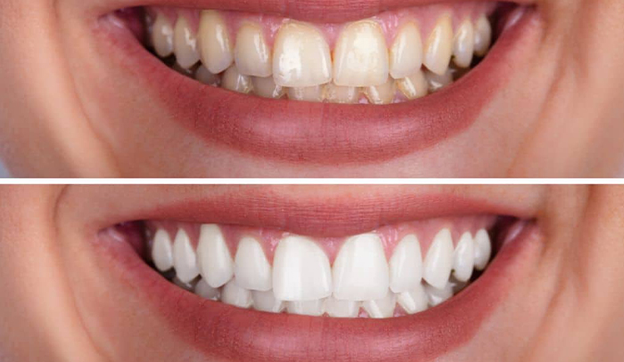 Teeth Cleaning vs. Whitening: What’s the Difference?