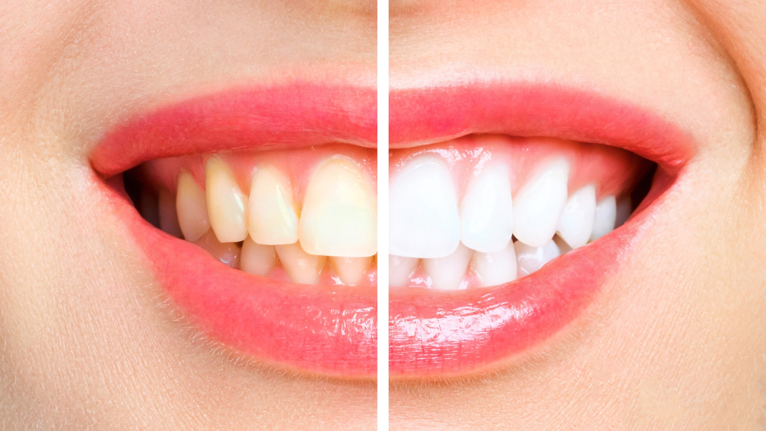teeth whitening in dentistry